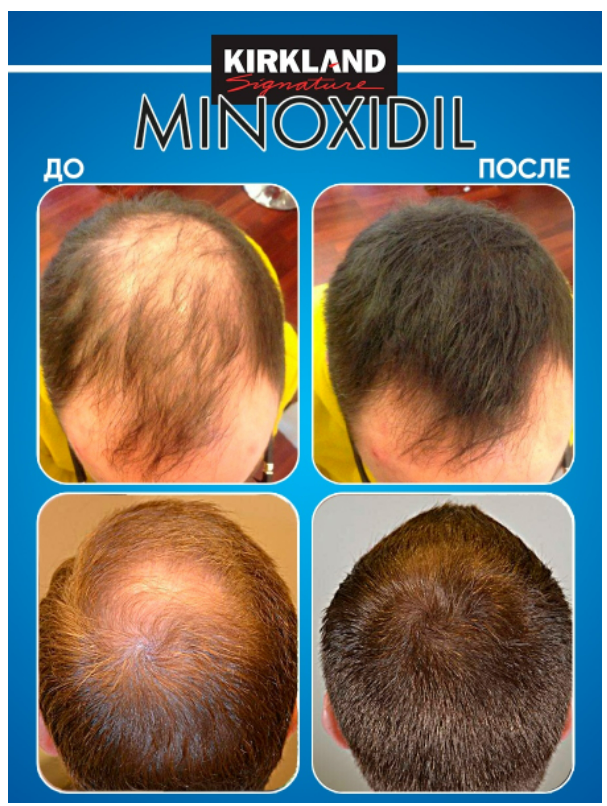 Сыворотка для роста волос Миноксидил Kirkland 5 усилитель роста бороды и волос 4 флакона