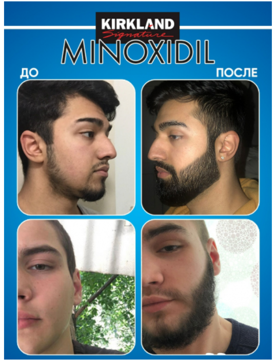 Миноксидил Киркланд 5%